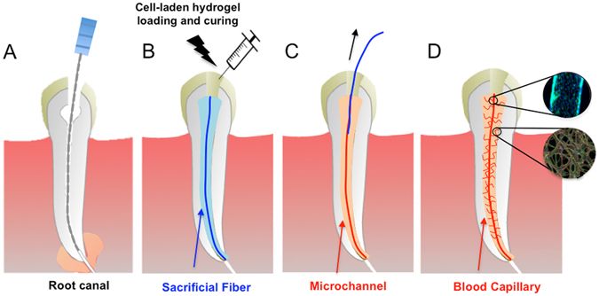 root canal therapy